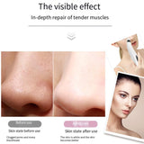 Electric Blackhead Remover Cleaner Face Diamond Pore Vacuum Suction White Heads